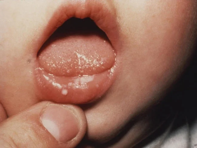 Nấm miệng ở trẻ 2 – 3 tuổi: Nguyên nhân và cách điều trị